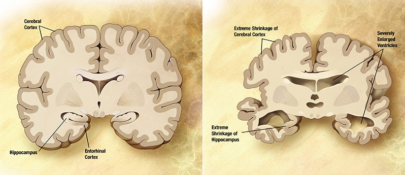 مقایسهی مغز سالم با مغز مبتلا به آلزایمر